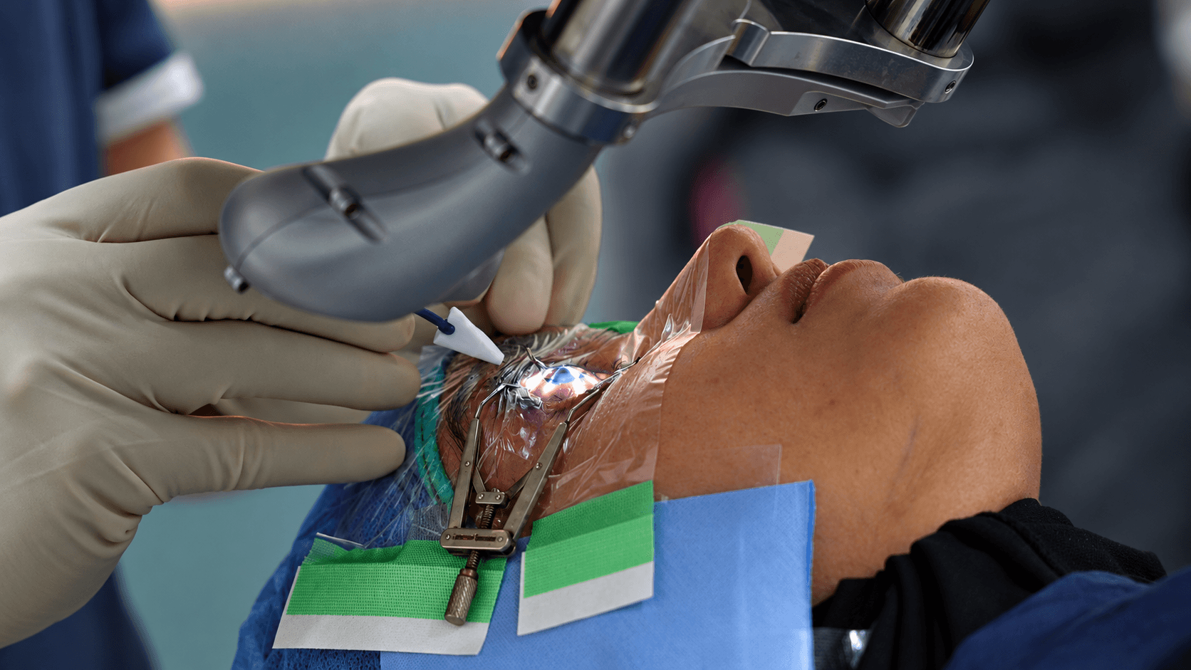 Glasses Removal Surgery in Pakistan: Types, Benefits and Procedures