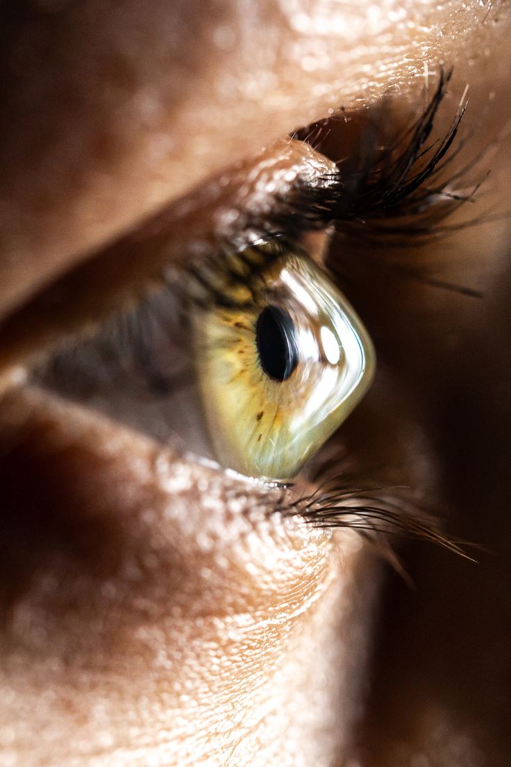 Keratoconus eye