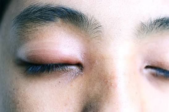 Oculoplasty slide 1