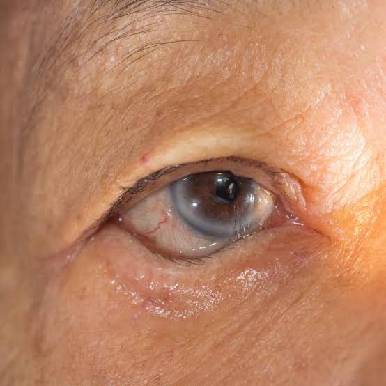Oculoplasty slide 3