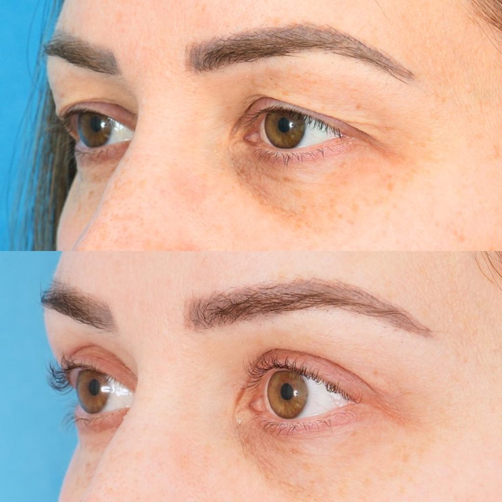 BLEPHAROPLASTY