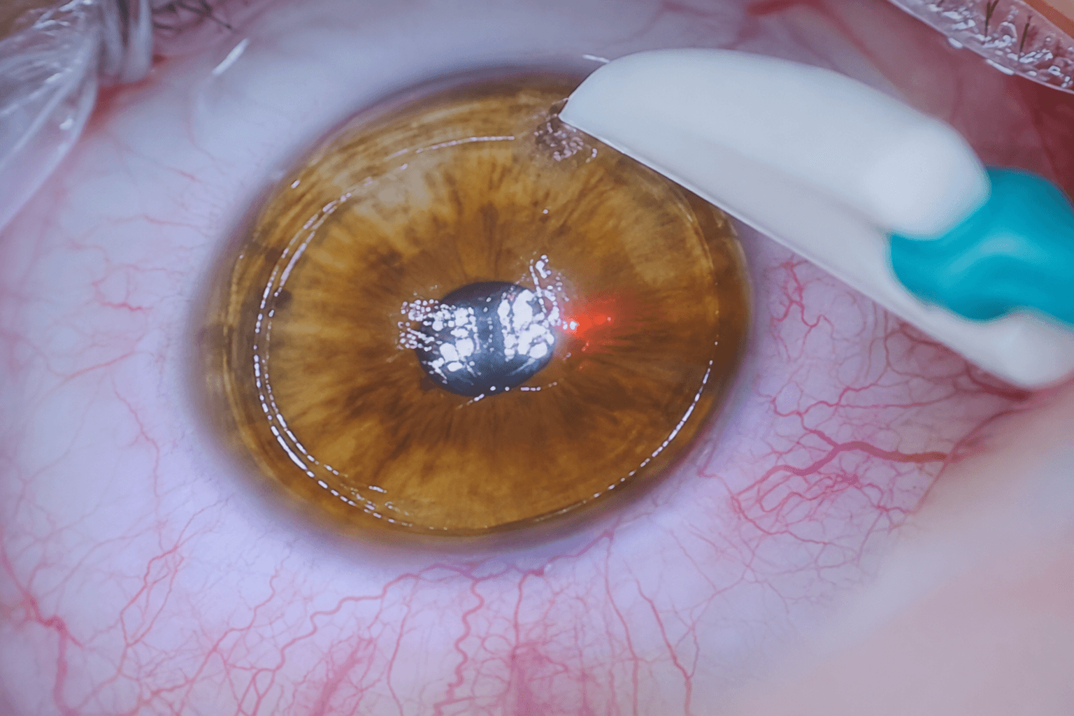 Laser & Vision Correction slide 1